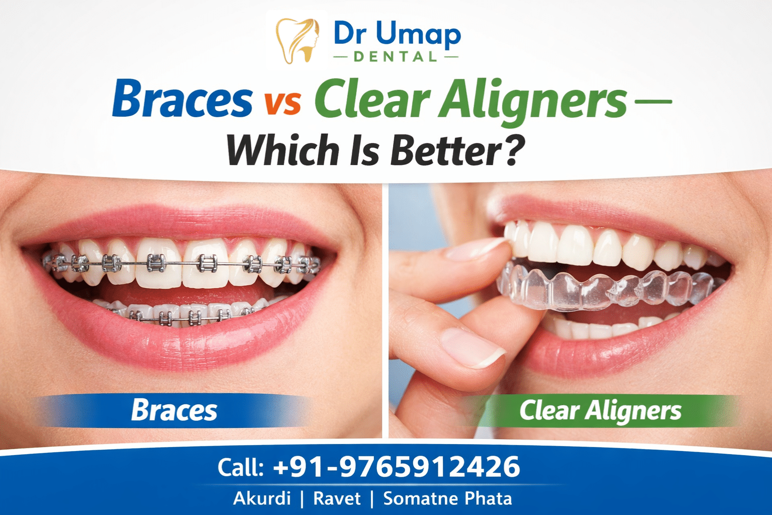 Braces vs Clear Aligners — Which Is Better?