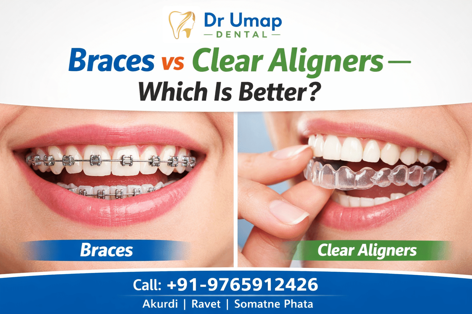Braces vs Clear Aligners — Which Is Better?